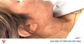 Người lớn gặp biến chứng nặng vì chủ quan bệnh sởi chỉ gặp ở trẻ em