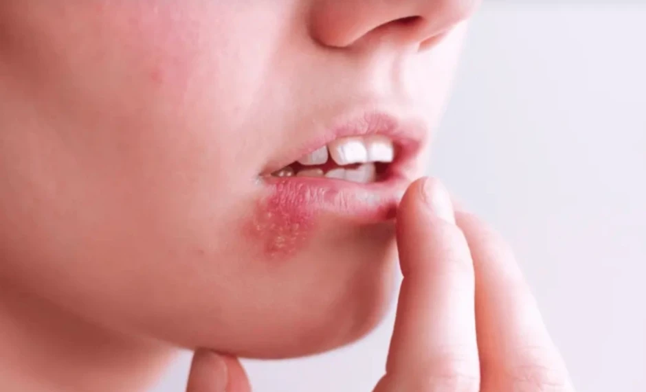 Người phụ nữ 30 tuổi chết não vì chủ quan với mụn rộp khóe miệng Người phụ nữ 30 tuổi chết não vì chủ quan với mụn rộp khóe miệng