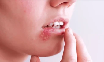 Người phụ nữ 30 tuổi chết não vì chủ quan với mụn rộp khóe miệng