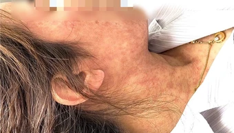 Người phụ nữ 42 tuổi bị nhiễm trùng, xuất huyết do biến chứng bệnh sởi, BS Bệnh viện Bệnh Nhiệt đới Trung ương nhắc làm ngay 1 việc để phòng tránh