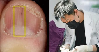 Người phụ nữ 45 tuổi phát hiện ung thư móng từ 1 dấu hiệu ở móng tay nhiều người bỏ qua