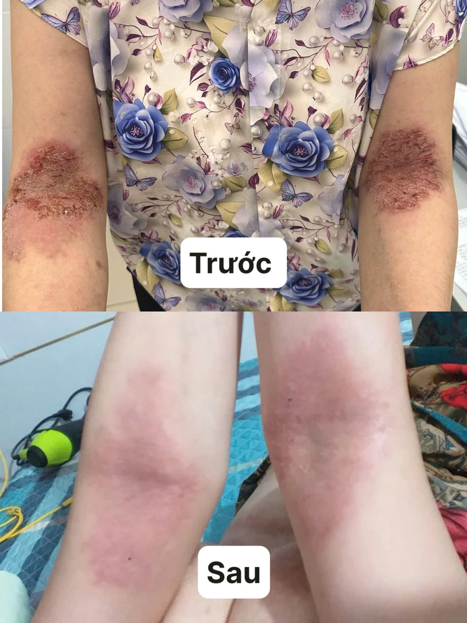 Người phụ nữ 6 năm sống trong đau đớn vì căn bệnh da di truyền hiếm gặp Người phụ nữ 6 năm sống trong đau đớn vì căn bệnh da di truyền hiếm gặp