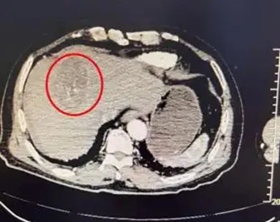 Người phụ nữ 70 tuổi vỡ khối u gan vì nhảy múa "quá mức" Người phụ nữ 70 tuổi vỡ khối u gan vì nhảy múa "quá mức"
