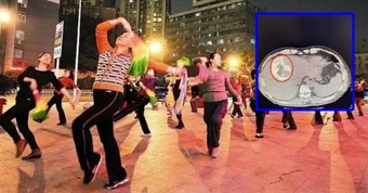 Người phụ nữ 70 tuổi vỡ khối u gan vì nhảy múa "quá mức"