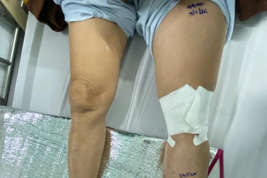 Người phụ nữ đột ngột phù một bên chân, chiến đấu với tử thần suốt 21 ngày Người phụ nữ đột ngột phù một bên chân, chiến đấu với tử thần suốt 21 ngày