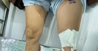 Người phụ nữ đột ngột phù một bên chân, chiến đấu với tử thần suốt 21 ngày