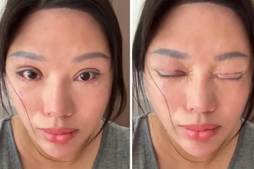 Người phụ nữ không thể nhắm mắt khi ngủ sau ca phẫu thuật thẩm mỹ hỏng Người phụ nữ không thể nhắm mắt khi ngủ sau ca phẫu thuật thẩm mỹ hỏng