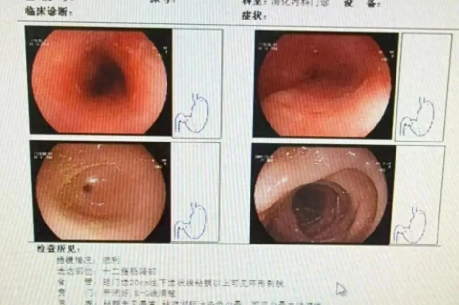 Người phụ nữ loét thực quản 8 cm vì nuốt vội thức ăn trong nồi lẩu Người phụ nữ loét thực quản 8 cm vì nuốt vội thức ăn trong nồi lẩu