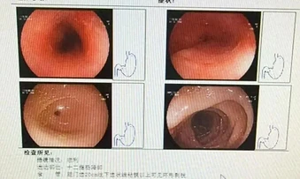 Người phụ nữ loét thực quản 8 cm vì nuốt vội thức ăn trong nồi lẩu