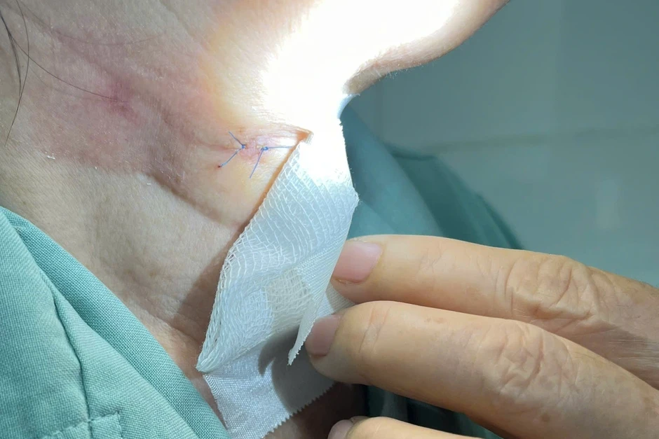 Người phụ nữ ở TPHCM nguy kịch sau mắc sốt xuất huyết, đường thở bị bít kín Người phụ nữ ở TPHCM nguy kịch sau mắc sốt xuất huyết, đường thở bị bít kín