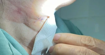 Người phụ nữ ở TPHCM nguy kịch sau mắc sốt xuất huyết, đường thở bị bít kín