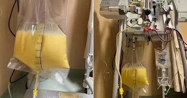 Người phụ nữ ra "máu trắng như sữa", bác sĩ lên tiếng cảnh báo Người phụ nữ ra "máu trắng như sữa", bác sĩ lên tiếng cảnh báo