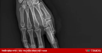 Nguy cơ mất chức năng bàn tay từ phút bất cẩn khi sử dụng máy cưa