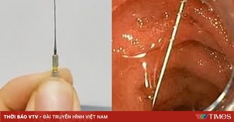 Nguy hiểm khi trẻ nuốt kim lấy tủy răng khi điều trị nha khoa