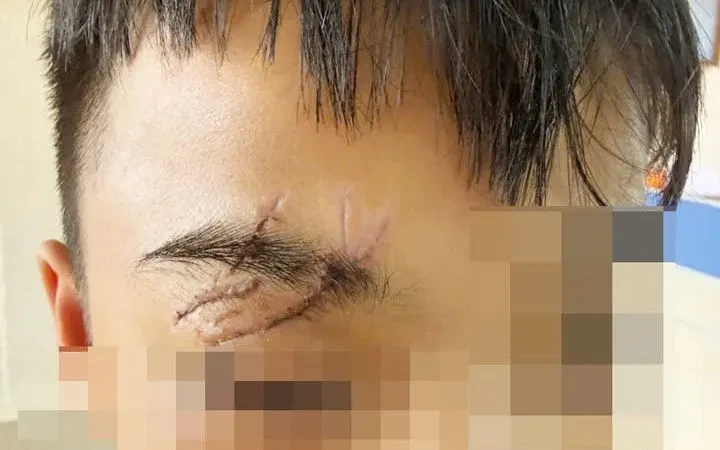 Nguy hiểm tai nạn thương tích ở trẻ em dịp nghỉ hè Nguy hiểm tai nạn thương tích ở trẻ em dịp nghỉ hè