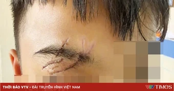 Nguy hiểm tai nạn thương tích ở trẻ em dịp nghỉ hè