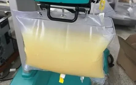 Nguy kịch vì viêm tụy cấp thể hoại tử nặng Nguy kịch vì viêm tụy cấp thể hoại tử nặng