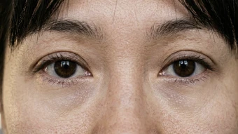 Nguyên nhân gây quầng thâm dưới mắt - Báo TinVina