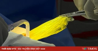 Nguyên nhân khiến túi ngực bị vỡ sớm