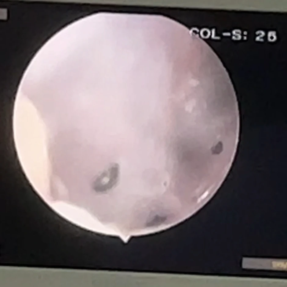 Nhà nuôi nhiều thú cưng, bé gái bị bọ chét chui vào tai ký sinh Nhà nuôi nhiều thú cưng, bé gái bị bọ chét chui vào tai ký sinh