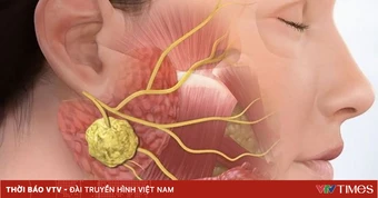 Nhận biết sớm quai bị để tránh biến chứng