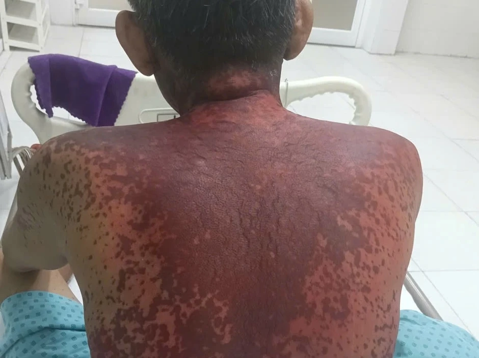 Nhiễm độc do dị ứng thuốc nhỏ mắt