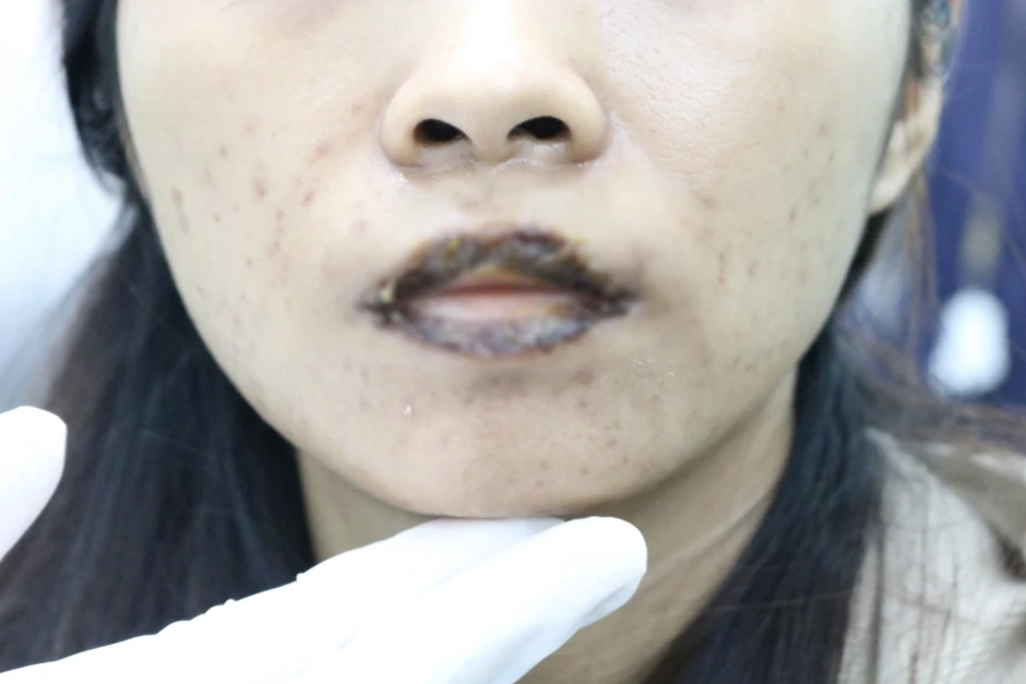 Nhiều người bỏng, biến dạng da khi làm đẹp: Thiết bị hiện đại là an toàn?
