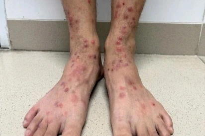 Nhiều người da nổi kín sẩn đỏ, ngứa ngáy vì bọ chét Nhiều người da nổi kín sẩn đỏ, ngứa ngáy vì bọ chét