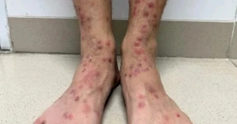 Nhiều người da nổi kín sẩn đỏ, ngứa ngáy vì bọ chét