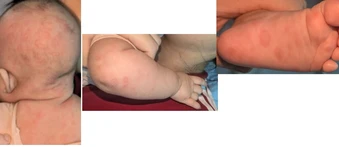 Nhiều trẻ mắc giang mai bẩm sinh vì mẹ bỏ lỡ xét nghiệm quan trọng