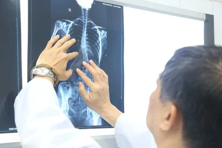Nhiều trẻ vẹo cột sống nặng mới đi khám, chuyên gia cảnh báo nguy cơ biến chứng nặng Nhiều trẻ vẹo cột sống nặng mới đi khám, chuyên gia cảnh báo nguy cơ biến chứng nặng