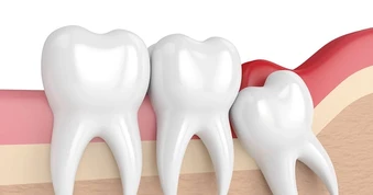 Nhổ răng khôn có được BHYT chi trả không?