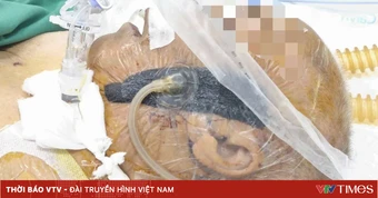 Nhổ răng khôn, cụ bà suýt tử vong vì sốc nhiễm khuẩn