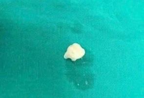 Nhổ răng tại nhà bằng sợi chỉ, bé trai 7 tuổi nuốt luôn chiếc răng cửa