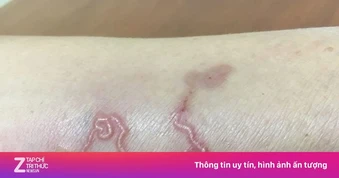 Nhóm người tuyệt đối không được quên tẩy giun