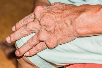 Những sai lầm của bệnh nhân gout khi điều trị khiến bệnh ngày càng nặng