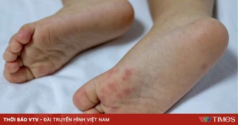 Những sai lầm trong điều trị tay chân miệng cho trẻ