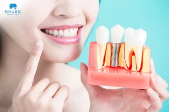 Những thông tin quan trọng về cấy ghép Implant