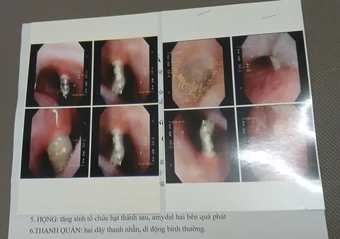 Niềng răng, vít chọc thẳng vào xoang mũi bệnh nhân, bệnh viện nói gì?
