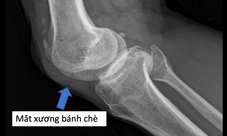 Nối mạch cứu đôi chân thương binh mất xương bánh chè nửa thế kỷ Nối mạch cứu đôi chân thương binh mất xương bánh chè nửa thế kỷ