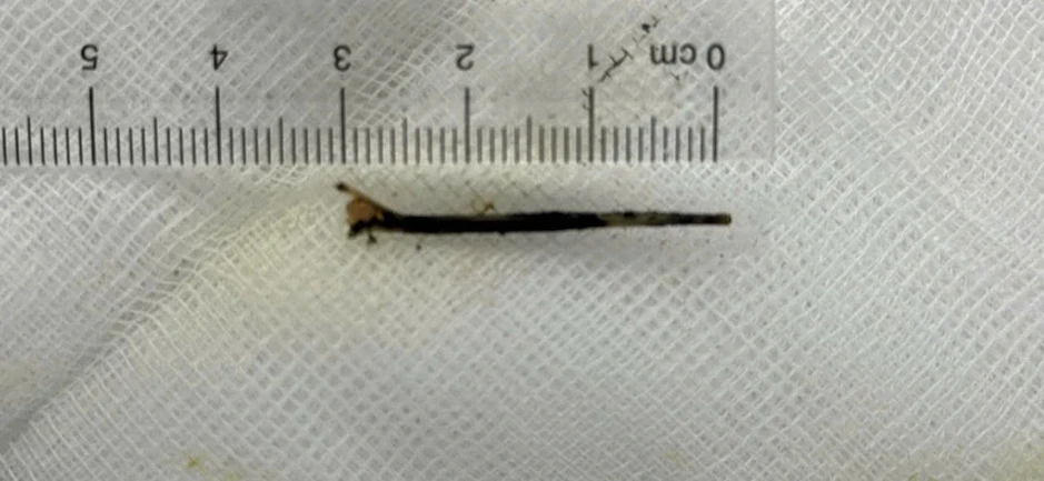 Nội soi lấy xương cá dài khoảng 3cm xuyên dạ dày vào đường mật của bệnh nhân