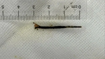 Nội soi lấy xương cá dài khoảng 3cm xuyên dạ dày vào đường mật của bệnh nhân