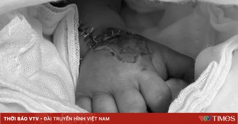 Nối thành công bàn tay bé 22 tháng tuổi bị đứt rời do máy dập cốc