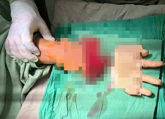 Nối thành công bàn tay đứt lìa của nam thanh niên Nối thành công bàn tay đứt lìa của nam thanh niên