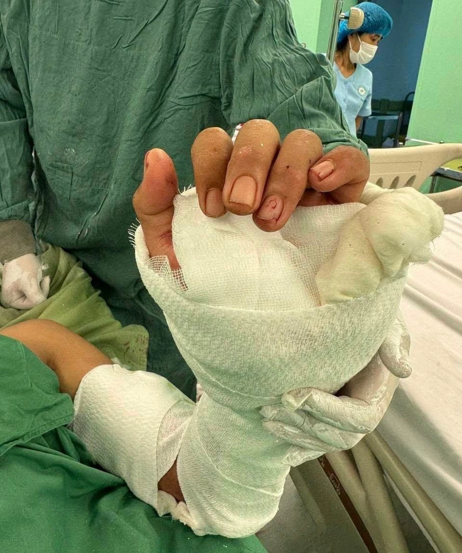 Nối thành công bàn tay đứt lìa của nam thanh niên Nối thành công bàn tay đứt lìa của nam thanh niên