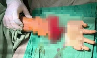 Nối thành công bàn tay đứt lìa của nam thanh niên