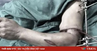 Nối thành công cánh tay đứt lìa trong "giờ vàng"