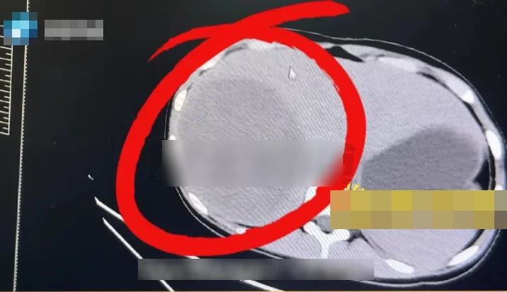 Nữ sinh lớp 10 phát hiện mắc ung thư gan, bác sĩ cảnh báo thói quen "nuôi tế bào ung thư" của nhiều người