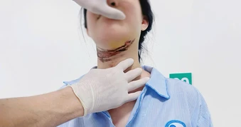 Nữ sinh nhập viện vì dây điện chùng ngang đường cuốn vào cổ