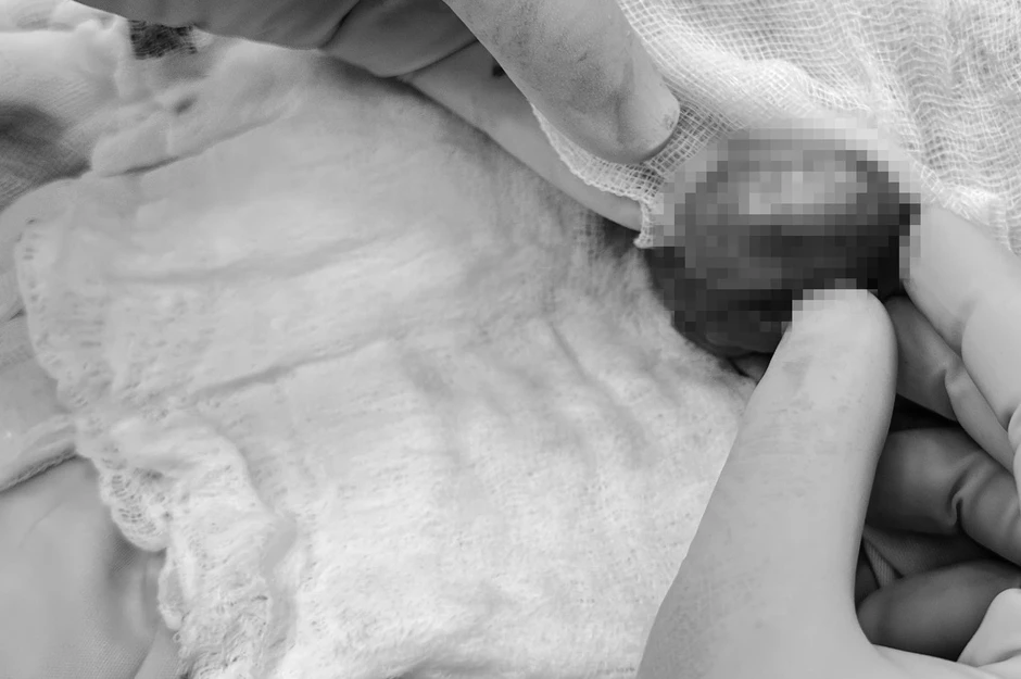 Nửa đêm đau âm ỉ vùng kín, nam sinh suýt mất tinh hoàn vì chủ quan